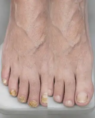 Before and After Treatment of Toenail Fungus Onychomycosis Clinical Photo