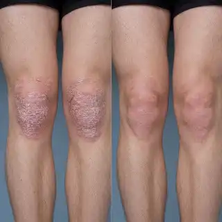 Psoriasis Treatment Before and After on Knees - Clinical Photo