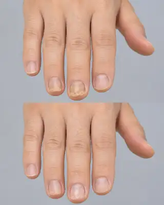Before and After Treatment of Fingernail Fungus Onychomycosis Infection