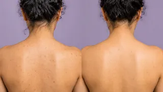 Before And After Back Acne Treatment Comparison Stock Photo