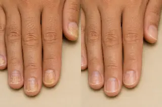 Before and After Treatment of Fingernail Fungus and Onychomycosis
