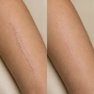 Before and After Treatment of Skin Scar on Patient Arm - Clinical Dermatology Stock Photo