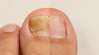 Before and After Treatment of Toenail Fungus Onychomycosis Stock Photo