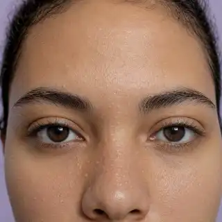 Closed Comedones and Whiteheads on Patient Forehead - Dermatology Stock Photo