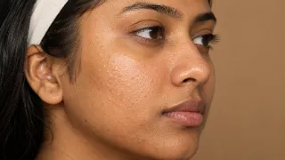 Close-up of Closed Comedodes and Acne Vulgaris on Young Woman Cheek