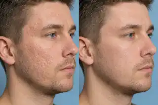 Before and After Deep Acne Scar Laser Resurfacing Treatment on Male Face