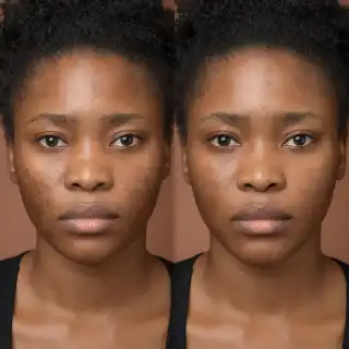 Before and After Dark Mark Peel Treatment on Patient Face