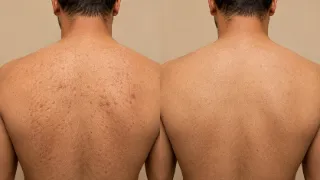 Before and After Back Acne Scar Laser Treatment Clinical Photo