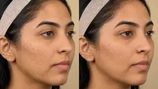 Cheek Micro Needling Acne Scars Before And After Clinical Stock Photo
