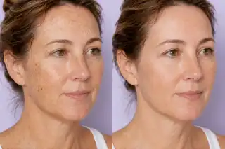 Sun Spot Laser Treatment Before And After Clinical Dermatology Photo