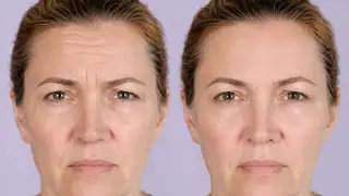 Forehead Botox Results Before and After Clinical Stock Photo