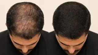 Hair Loss Treatment Results Before And After Vertex Density Comparison Stock Photo
