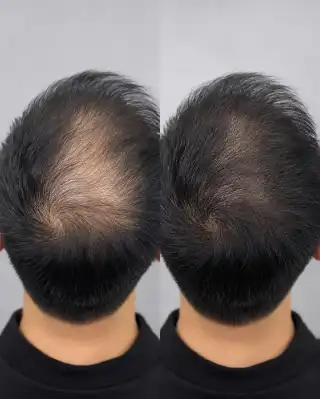 Crown Hair Recovery Before and After Alopecia Treatment - Clinical Photo