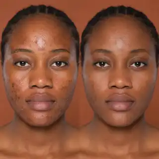 Full Face Acne Recovery Before and After Treatment Clinical Photo