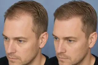 Receding Hairline Before and After Hair Restoration Treatment - Clinical Photo