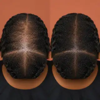 Diffuse Crown Hair Loss and Regrowth Comparison - Dermatology Stock Photo