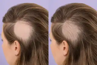 Alopecia Areata Patch Hair Loss Treatment Results Stock Photo