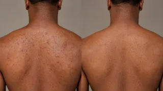 Before and After Back Acne Treatment Results Clinical Photo