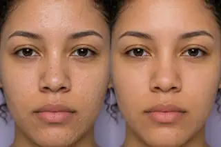 Comedonal Acne Treatment Results Before and After Clinical Stock Photo