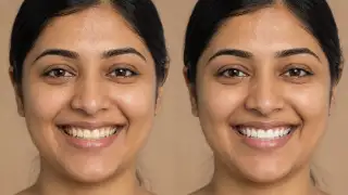 Teeth Whitening Before and After Smile Comparison