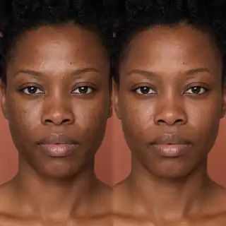 Hyperpigmentation Treatment Before and After on Dark Skin Face