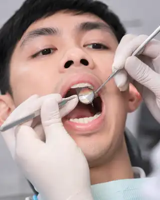 Front Tooth Dental Filling Procedure by Dentist - Clinical Stock Photo