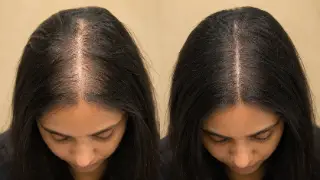 Female Hair Loss Treatment Results Showing Before and After PRP Therapy - Clinical Photo
