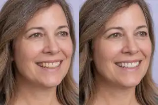 Mature Woman Teeth Whitening Results Before And After Comparison