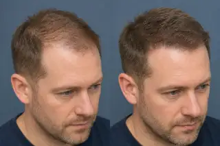 Hairline Restoration Results Before and After PRP Therapy - Clinical Photo