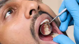 Dentist Examining Patient Teeth With Dental Mirror - Clinical Dentistry Stock Photo