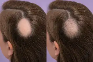 Alopecia Areata Before And After PRP Treatment Clinical Stock Photo