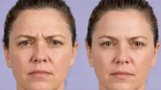Forehead Botox Results Comparison Showing Wrinkle Reduction in Woman