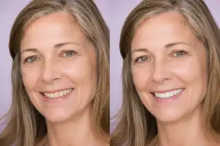 Teeth Whitening Before and After Smile Makeover Clinical Photo