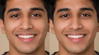 Chipped Tooth Bonding Before and After Dental Procedure Stock Photo