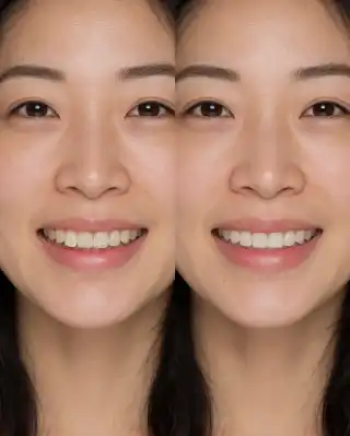 Dental Composite Bonding Before and After Showing Worn Edge Repair