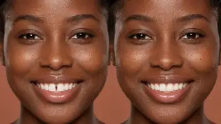 Before and After Front Tooth Gap Closure Dental Treatment Photo