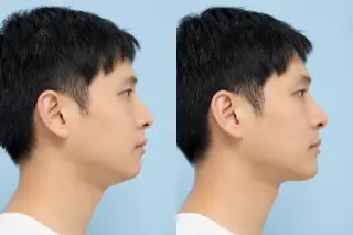 Before and After Nasolabial Filler Treatment on Male Patient Profile