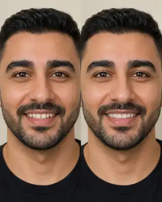 Dental Patient Before and After Lateral Gap Closure and Smile Makeover