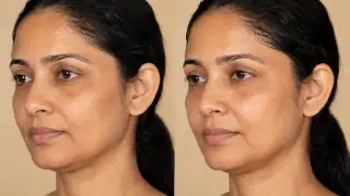 Rejuvenated Skin Results Before and After Aesthetic Treatment Stock Photo