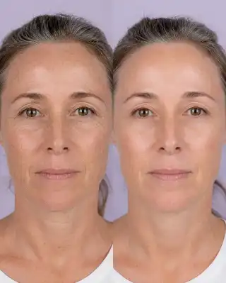 Mature Female Face Before and After Facial Rejuvenation Results