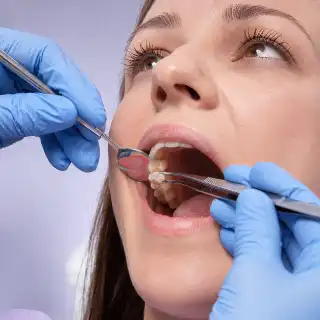 Dentist Placing Ceramic Inlay in Patient Molar Tooth - Clinical Dentistry Photo