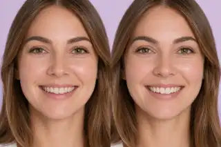 Before And After Incisal Edge Contouring Dental Procedure Stock Photo