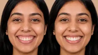 Gummy Smile Before and After Contouring Treatment - Dental Photo