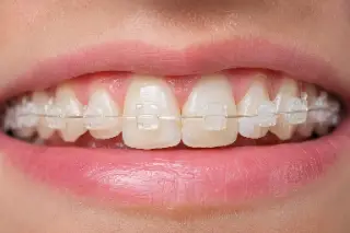 Closeup View of Ceramic Orthodontic Braces on Teeth - Dental Stock Photo