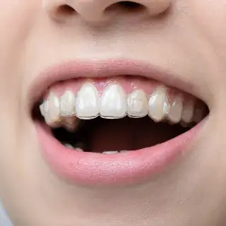Patient Wearing Clear Aligner Tray and Attachments - Dentistry Stock Photo