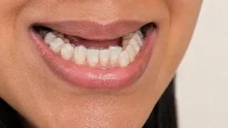 Patient Smiling Showing Clear Aligner With Composite Attachments - Dentistry Stock Photo