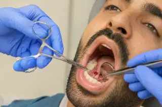 Dentist Suturing Gum After Oral Surgery - Dental Procedure Photo