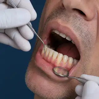Detailed Clinical View of Gum Recession on Lower Teeth - Dental Photo